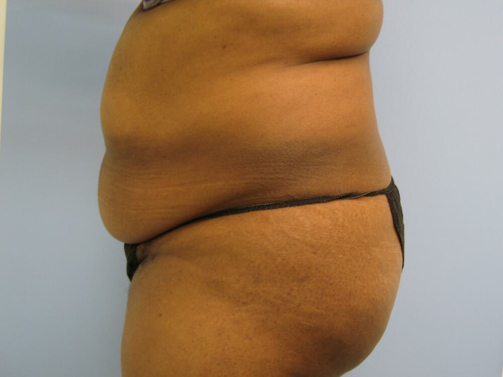 Tummy Tuck Before & After Image