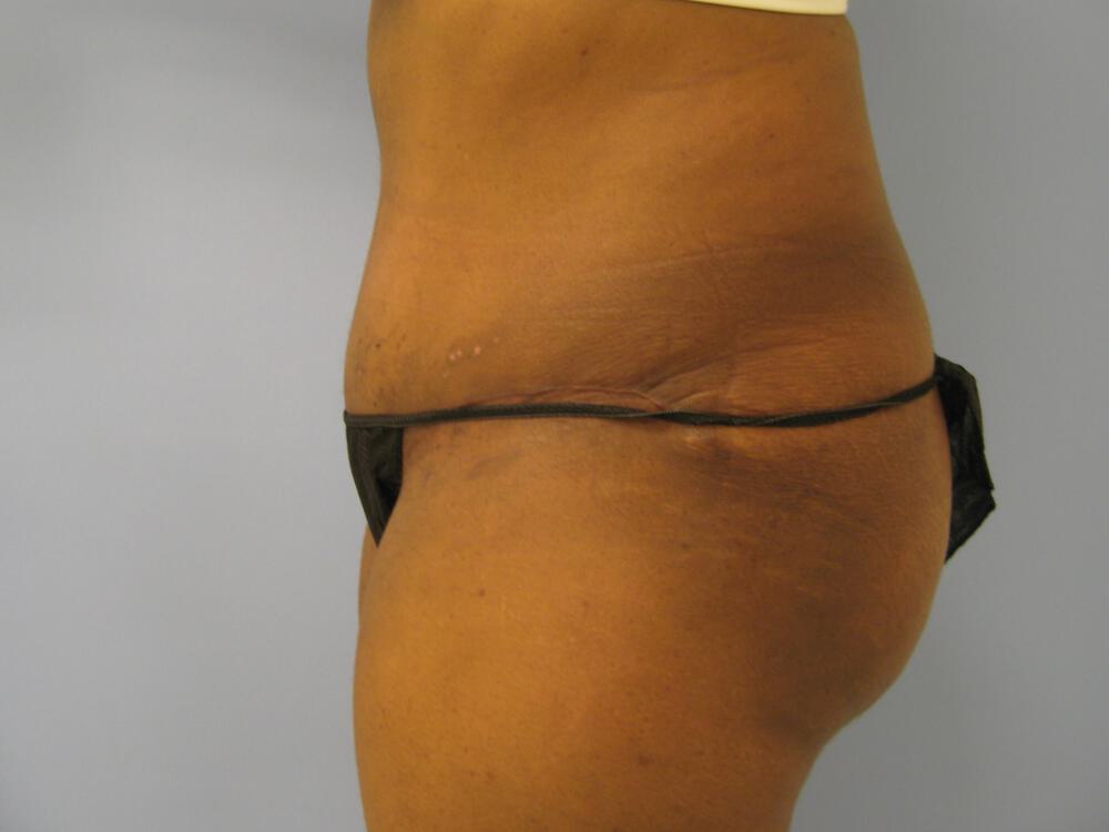 Tummy Tuck Before & After Image
