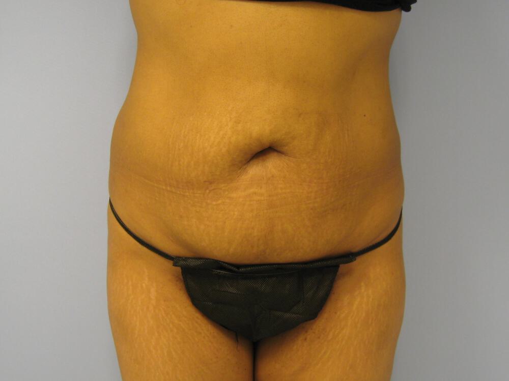 Tummy tuck Before & After Image