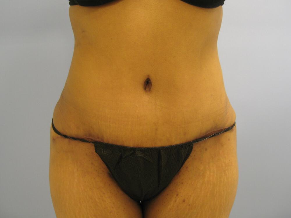 Tummy tuck Before & After Image