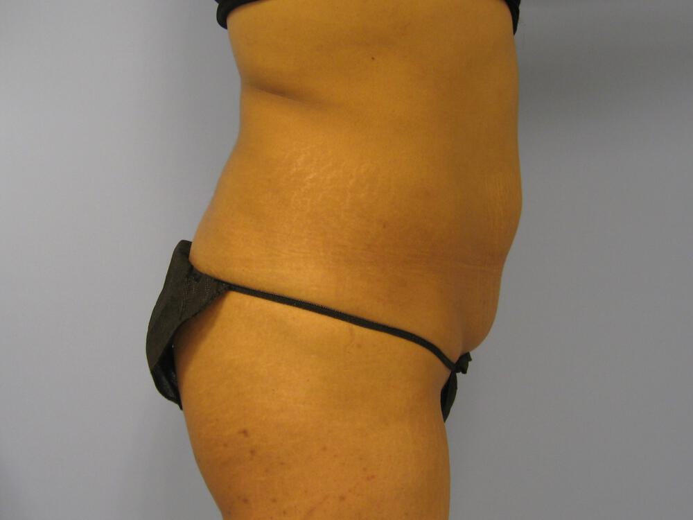 Tummy tuck Before & After Image