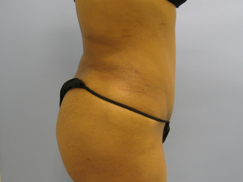 Tummy tuck Before & After Image