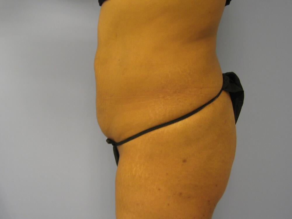 Tummy Tuck Before & After Image