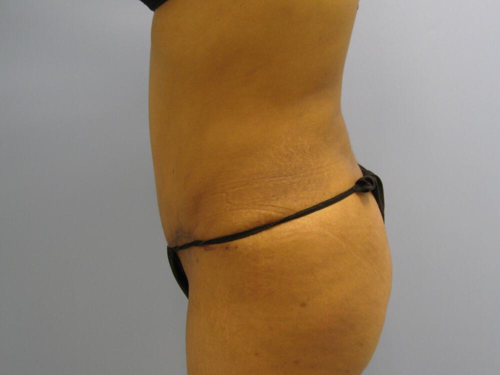Tummy Tuck Before & After Image