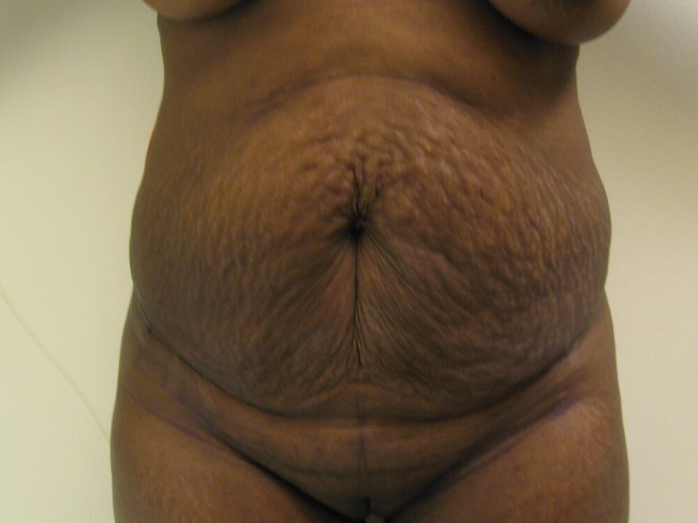 Tummy tuck Before & After Image