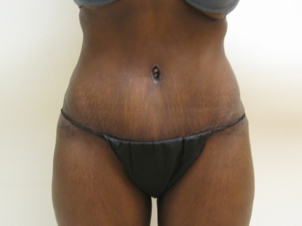 Tummy tuck Before & After Image