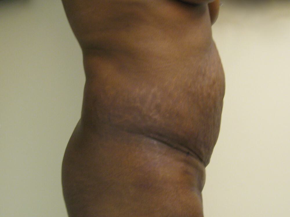 Tummy tuck Before & After Image