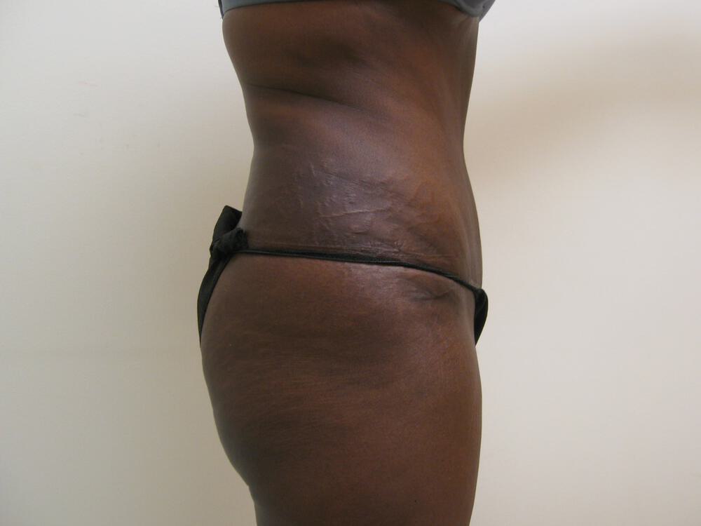 Tummy tuck Before & After Image