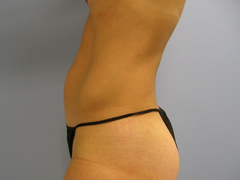 Tummy tuck Before & After Image