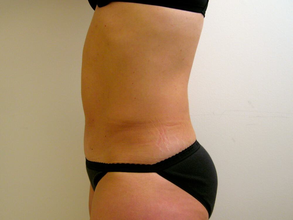 Tummy tuck Before & After Image