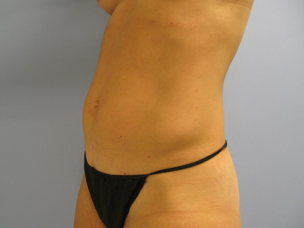Tummy tuck Before & After Image