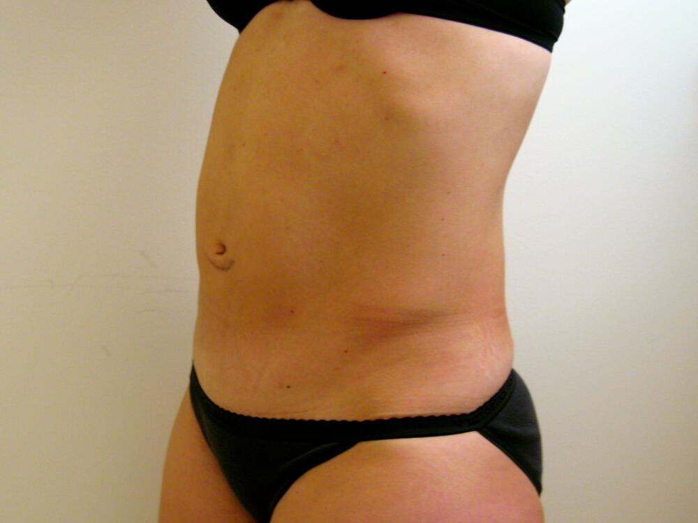 Tummy tuck Before & After Image