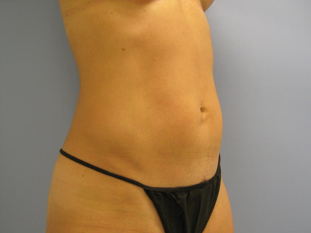 Tummy Tuck Before & After Image