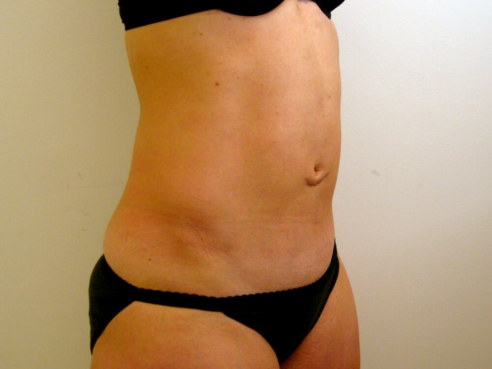 Tummy Tuck Before & After Image