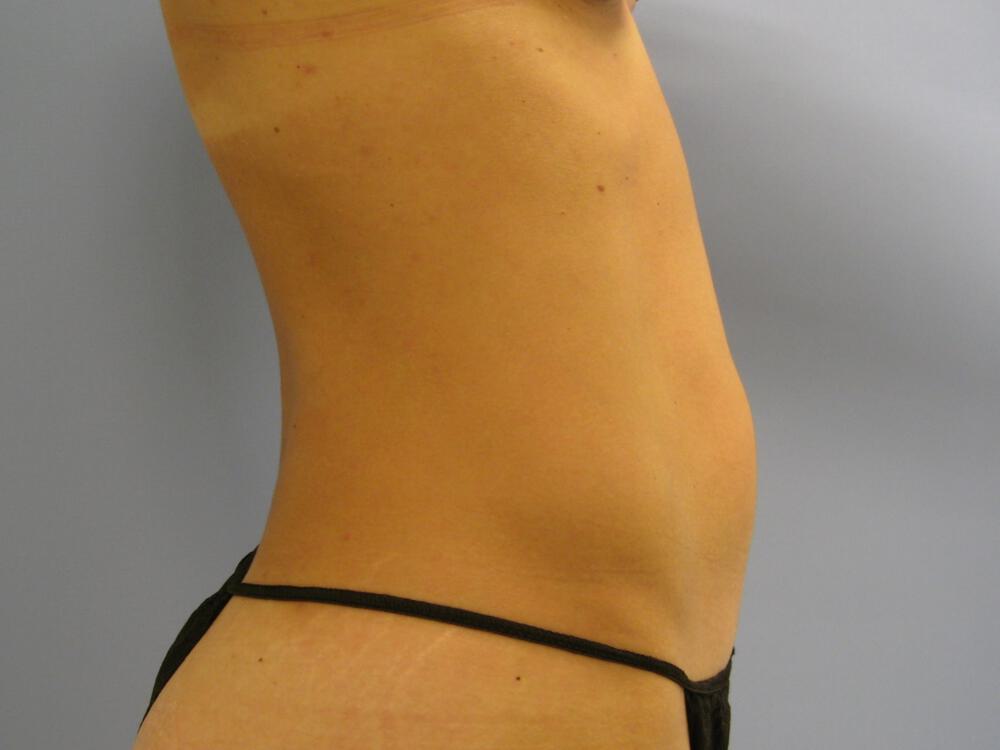Tummy Tuck Before & After Image