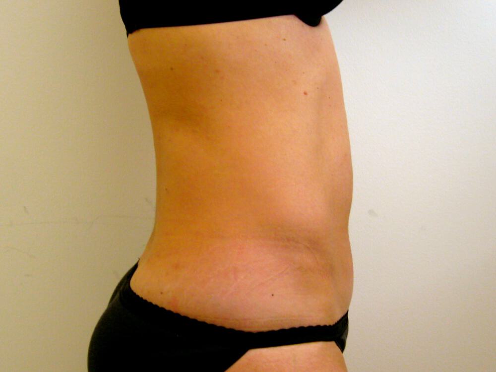 Tummy Tuck Before & After Image