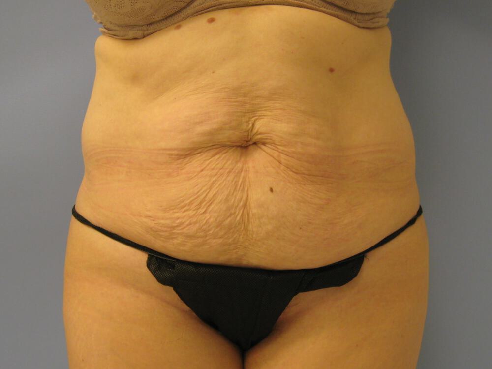 Tummy tuck Before & After Image