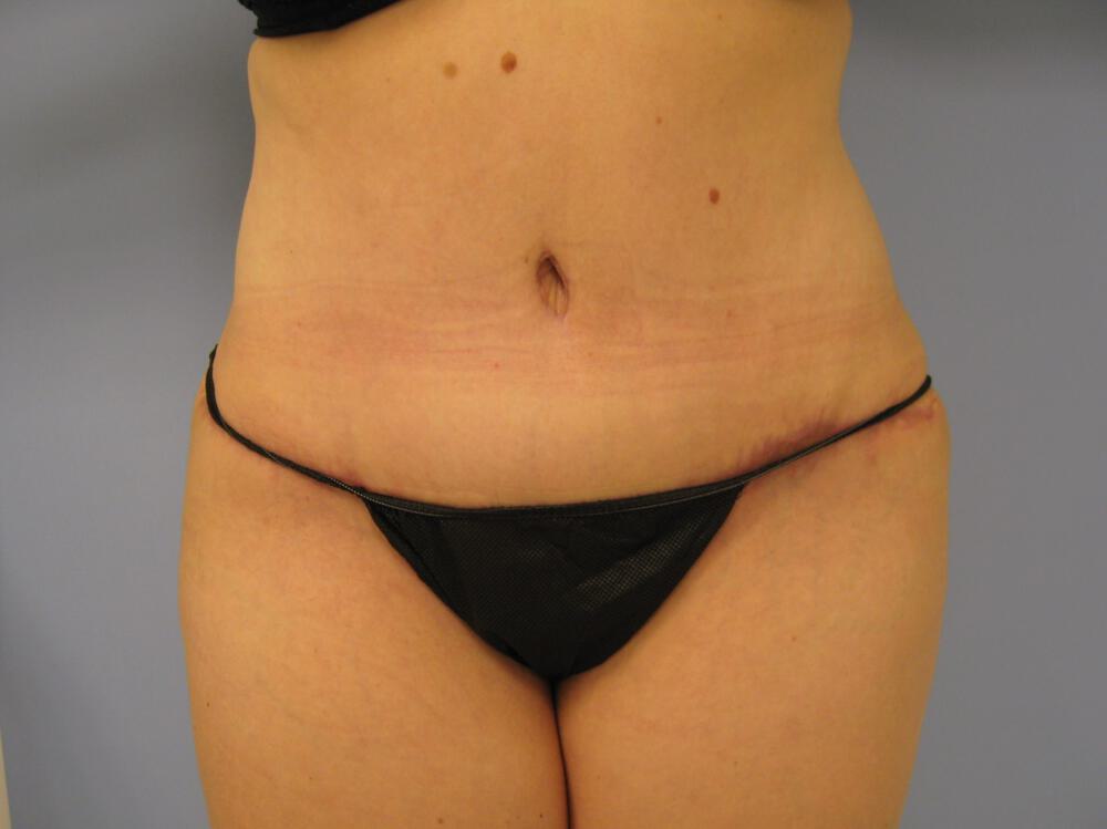 Tummy tuck Before & After Image