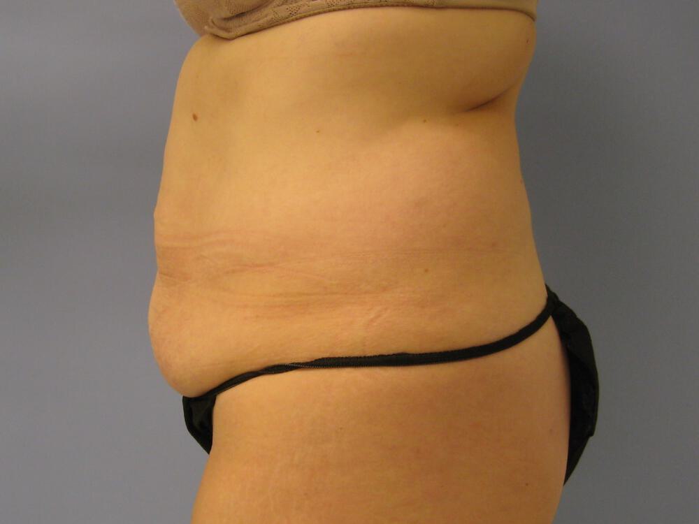 Tummy tuck Before & After Image