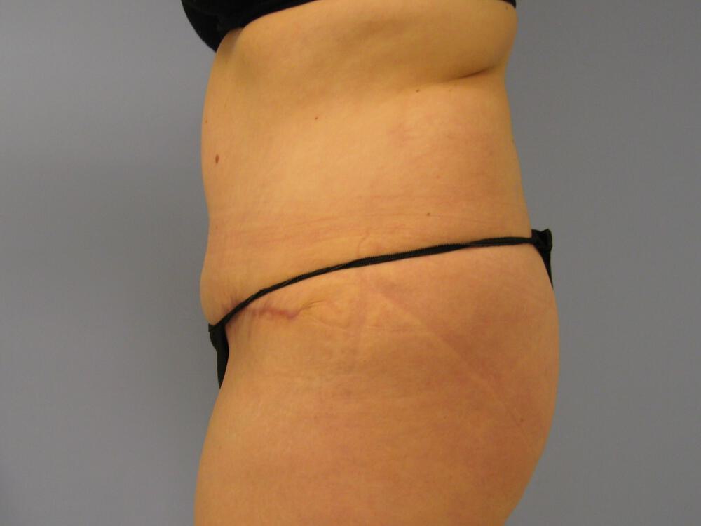 Tummy tuck Before & After Image