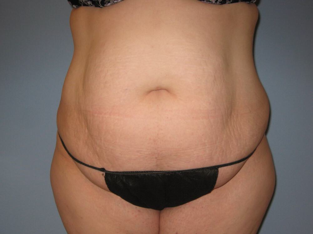 Tummy tuck Before & After Image