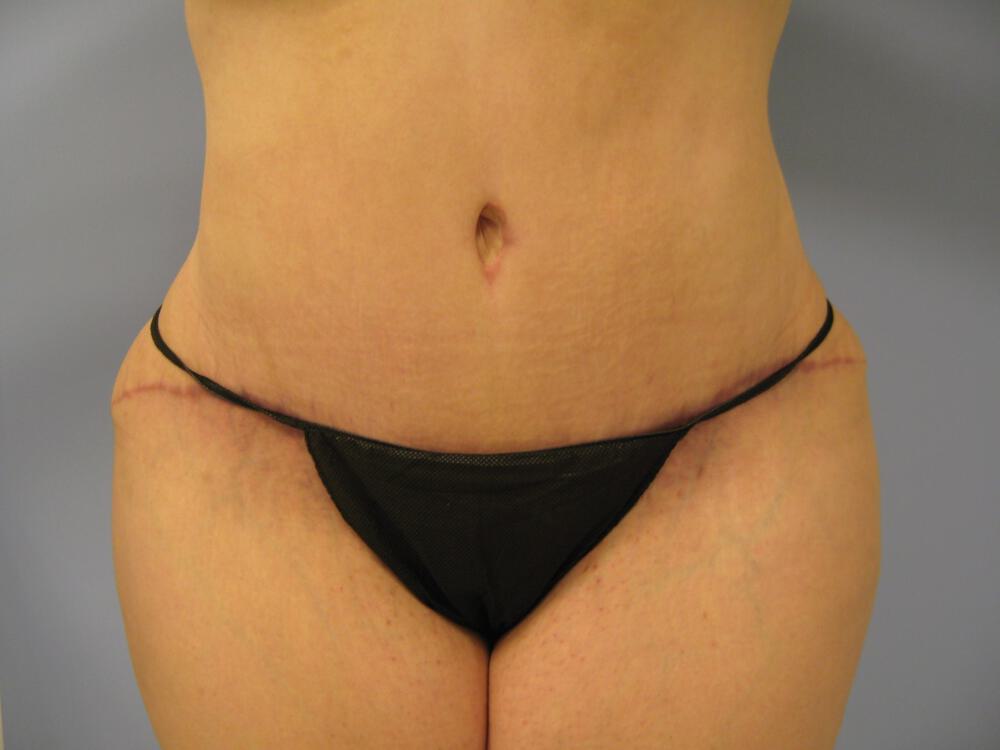 Tummy tuck Before & After Image