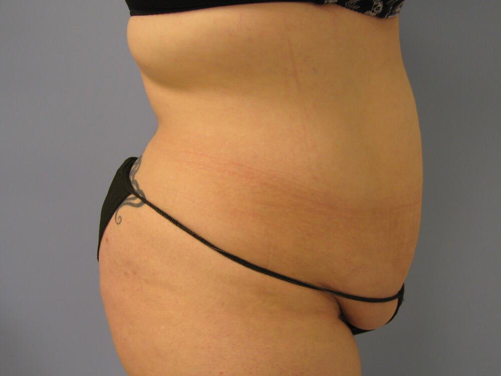 Tummy tuck Before & After Image