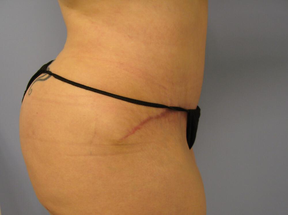 Tummy tuck Before & After Image