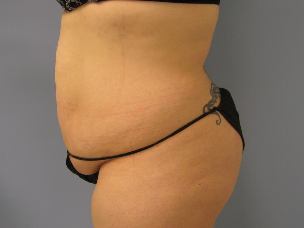 Tummy Tuck Before & After Image