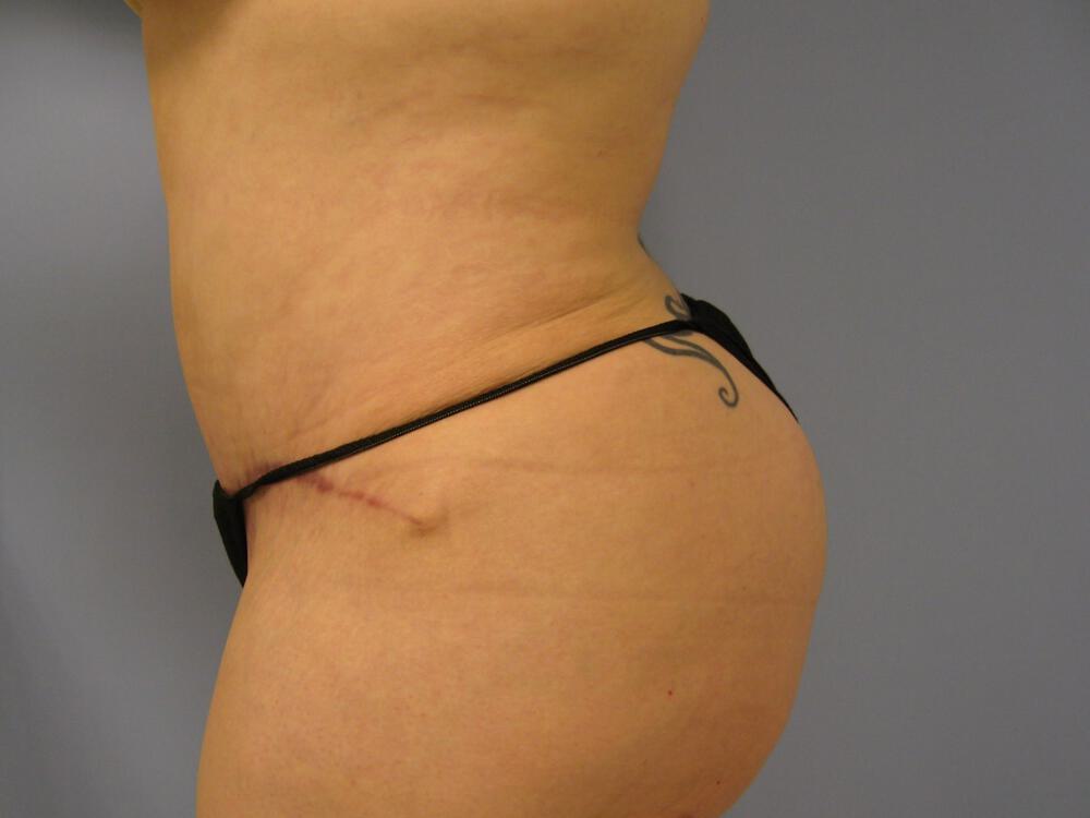 Tummy Tuck Before & After Image