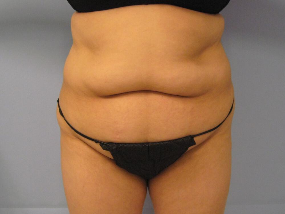 Tummy tuck Before & After Image