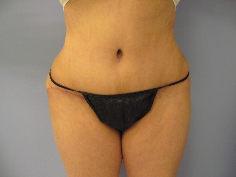 Tummy tuck Before & After Image