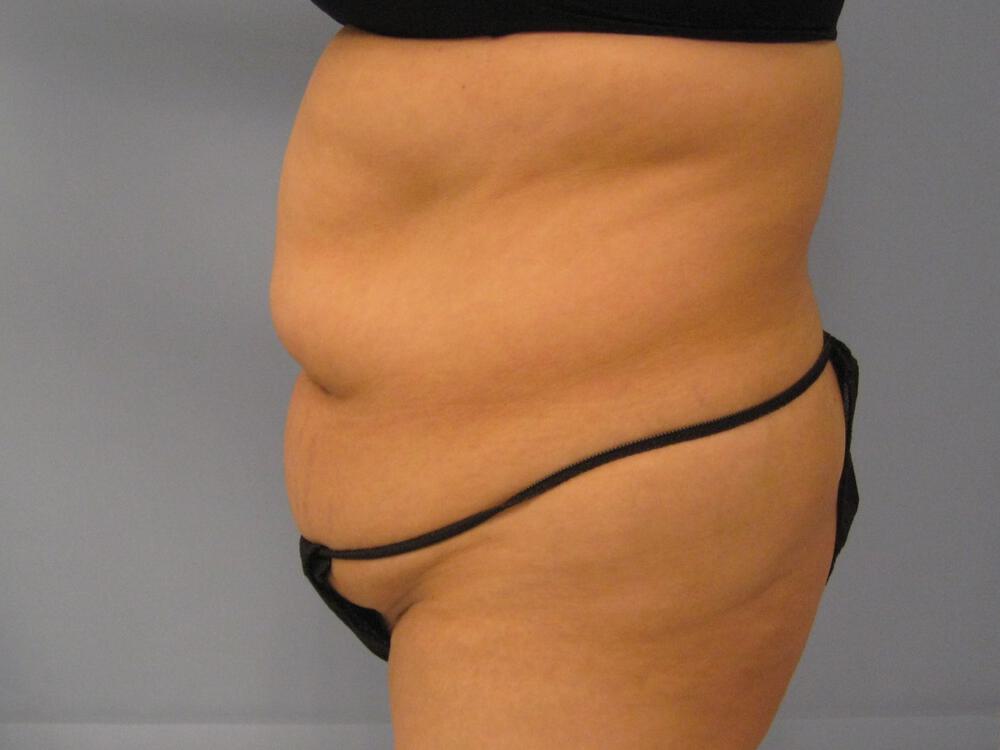 Tummy tuck Before & After Image