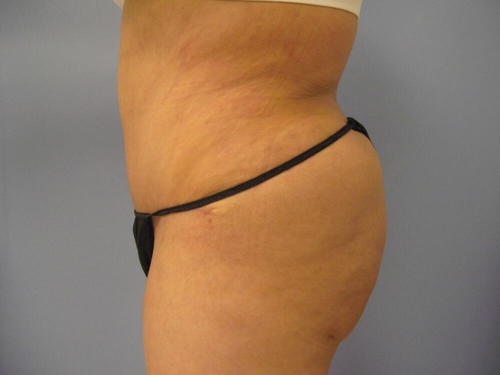 Tummy tuck Before & After Image