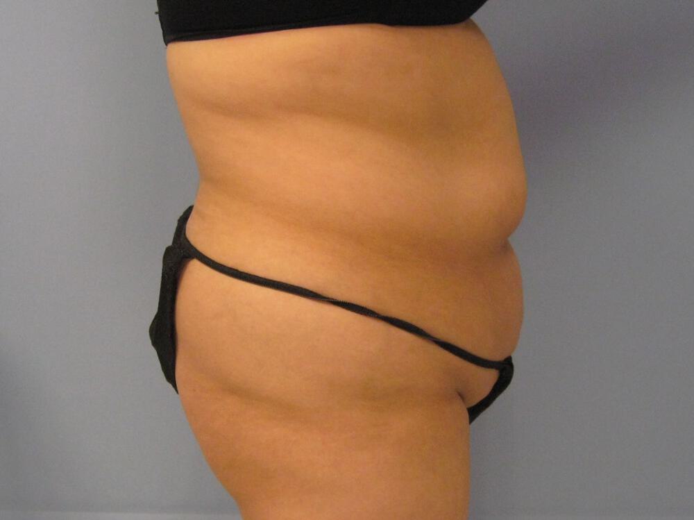 Tummy Tuck Before & After Image