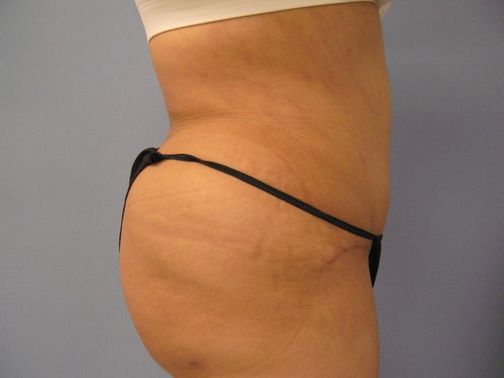 Tummy Tuck Before & After Image