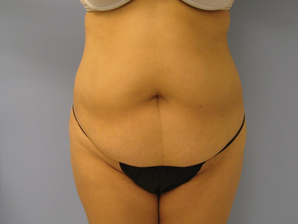 Tummy tuck Before & After Image