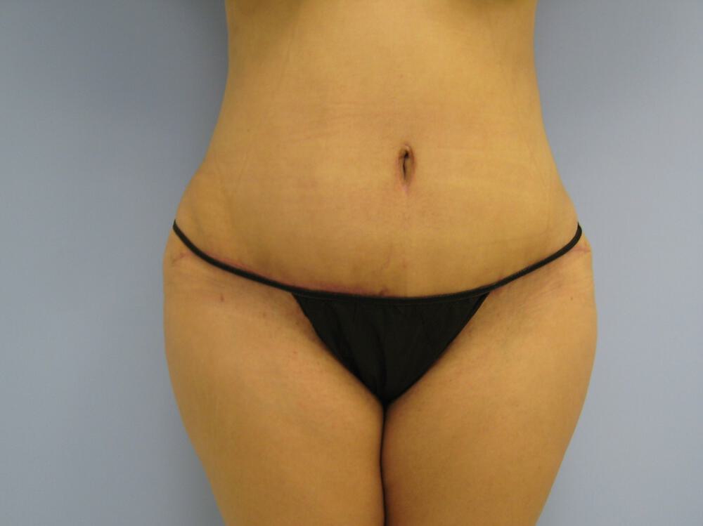 Tummy tuck Before & After Image