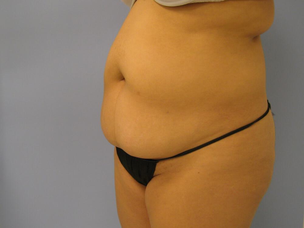 Tummy tuck Before & After Image