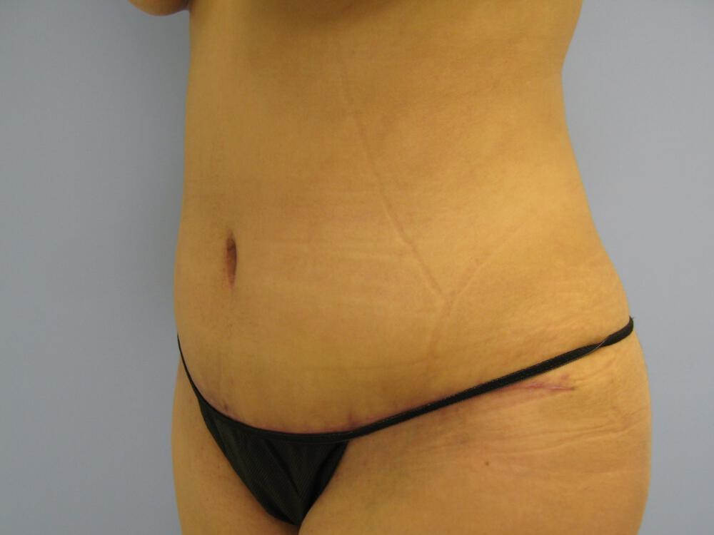 Tummy tuck Before & After Image