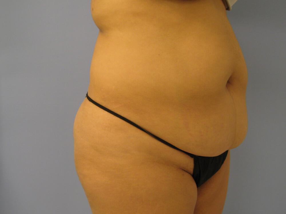 Tummy Tuck Before & After Image
