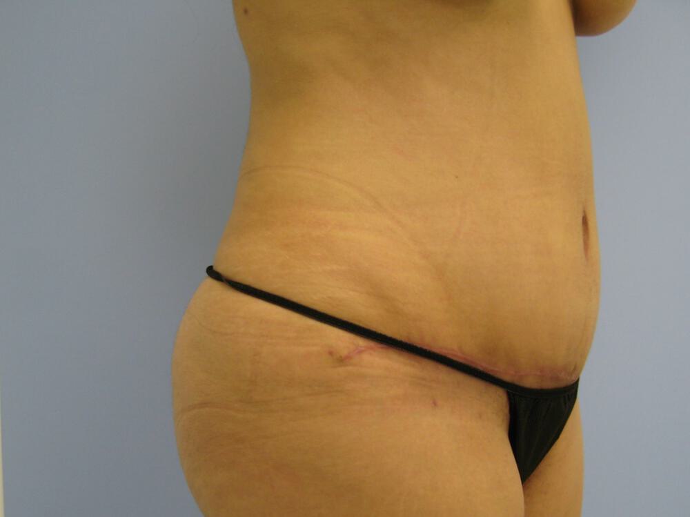 Tummy Tuck Before & After Image