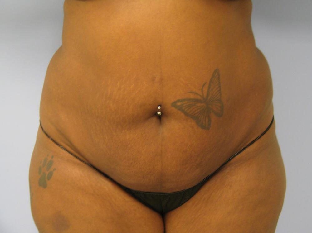 Tummy tuck Before & After Image