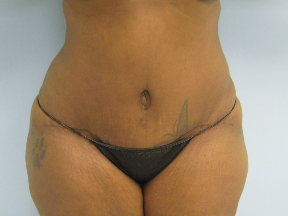 Tummy tuck Before & After Image