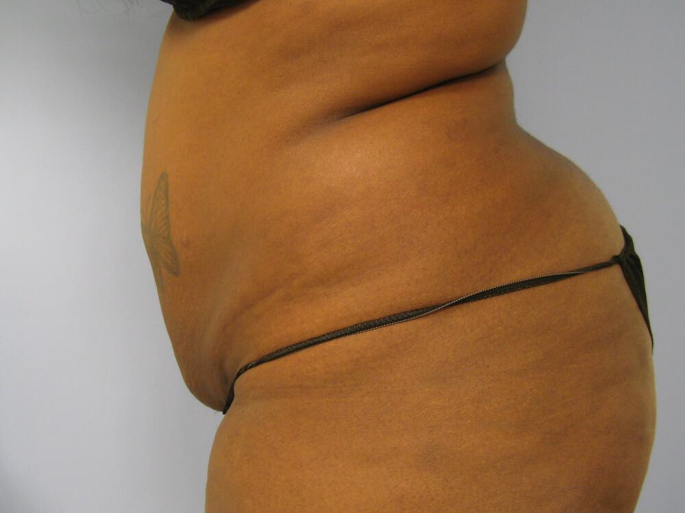 Tummy tuck Before & After Image