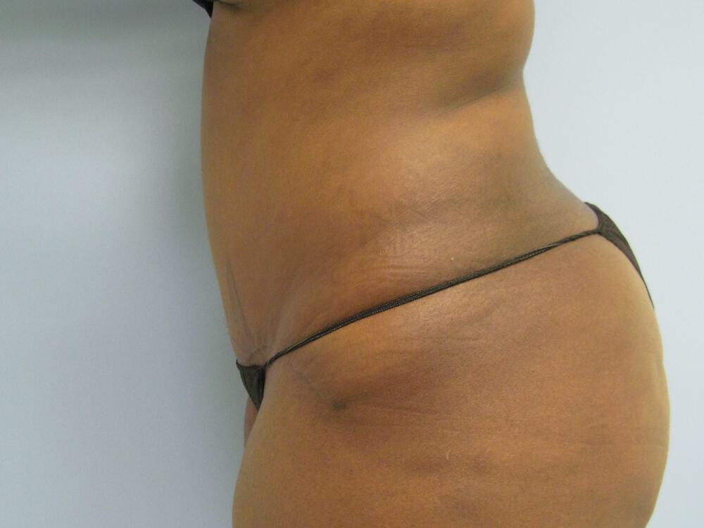 Tummy tuck Before & After Image