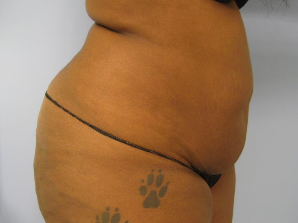 Tummy Tuck Before & After Image