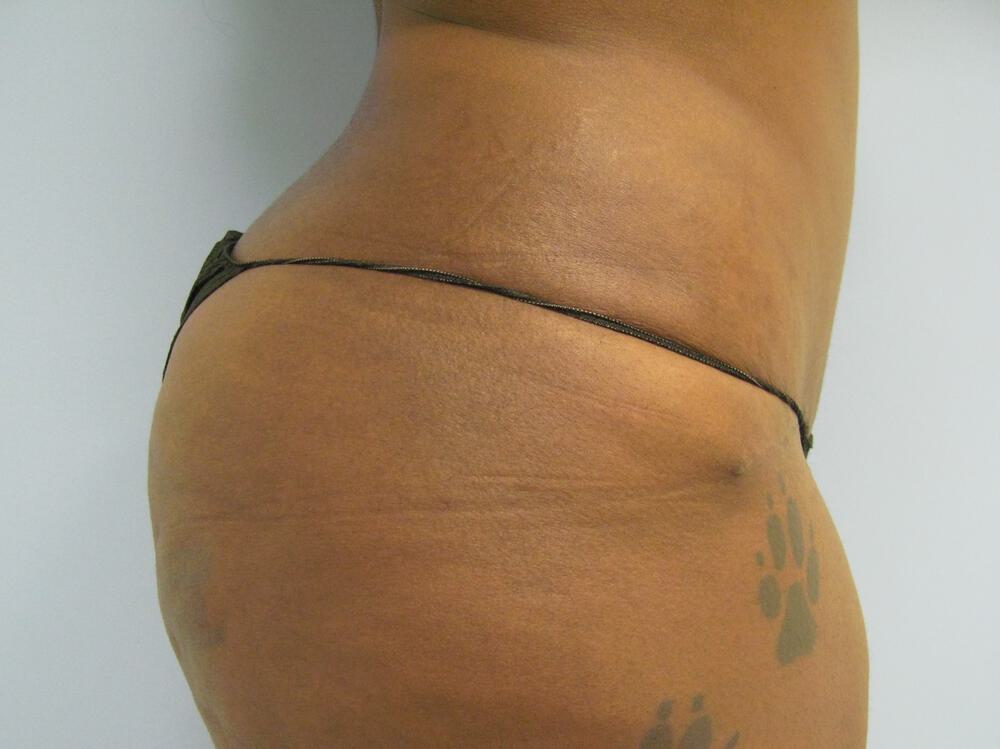 Tummy Tuck Before & After Image