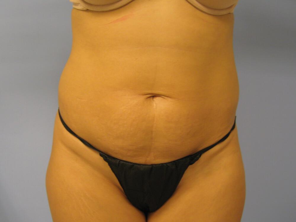 Tummy tuck Before & After Image