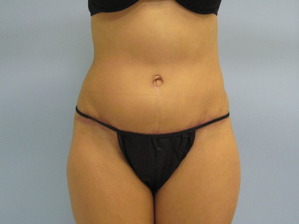 Tummy tuck Before & After Image